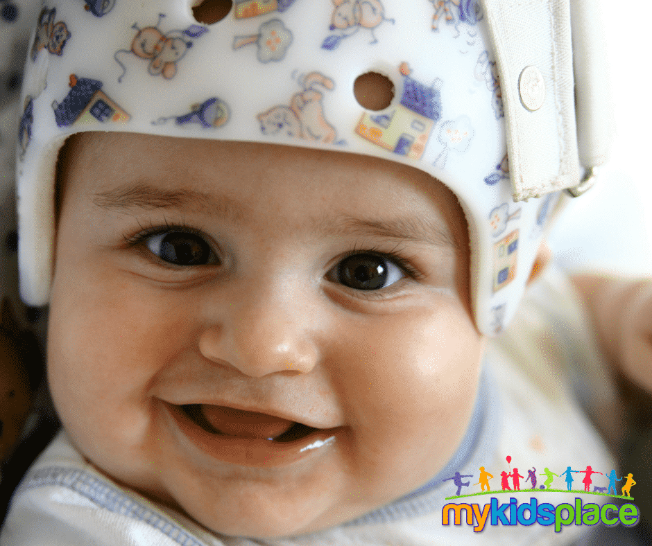 Smiling baby wearing a helmet to correct flat head syndrome